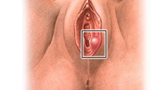 vaginal cyst symptoms